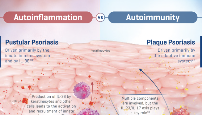 IL-36 Pustular Psoriasis-Factsheet