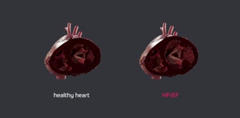 Heart Failure with Reduced Ejection Fraction - Video
