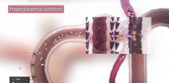 Kidney and DKD Pathophysiology - Video