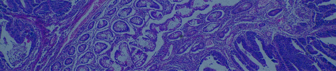View of Adenocarcinoma in human tumor tissue
through micrograph